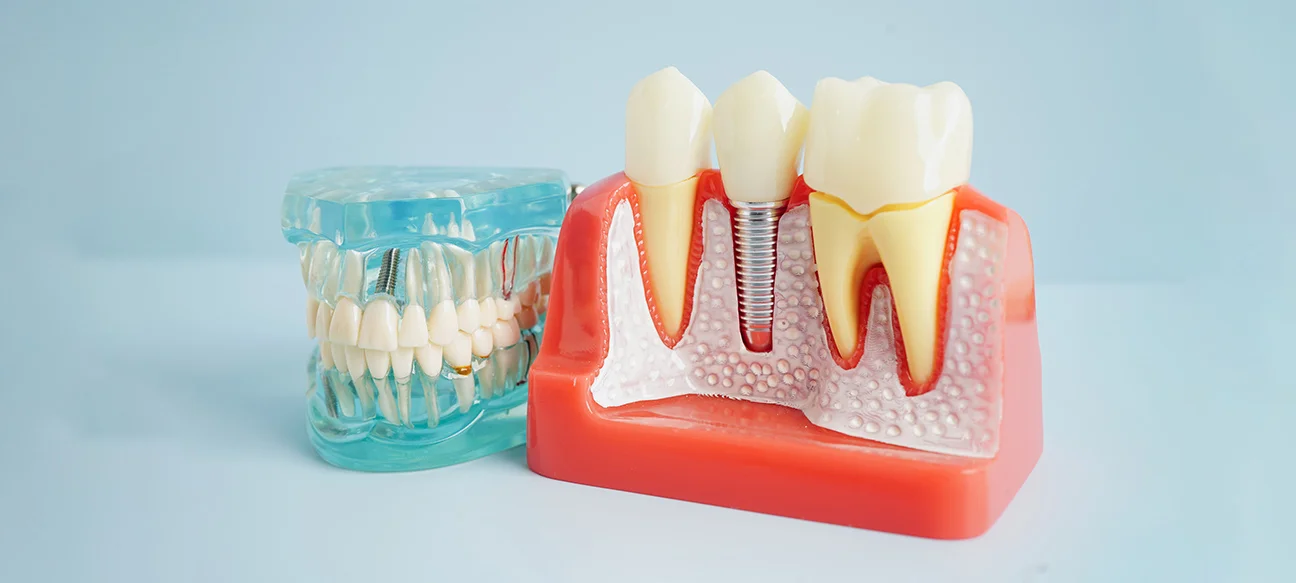 Dental Implants